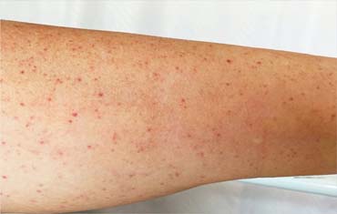 autoimmune treatment in gandhinagar