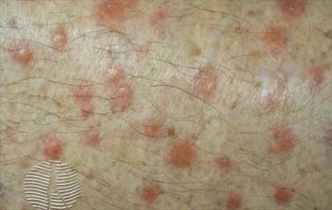 autoimmune treatment in gandhinagar
